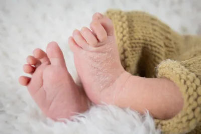 Close-up of newborn baby feet with dry peeling skin resting on a soft white fur blanket.